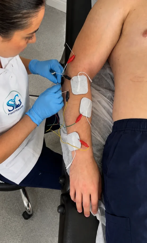 Fisioterapeuta realizando neuromodulación percutánea en brazo durante tratamiento de fisioterapia en Sevilla